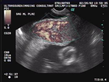 Complications of Placenta Previa