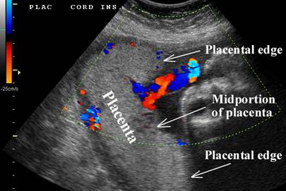 Velamentous Cord Insertion Ultrasound Velamentous Cord Insertion Ultrasound