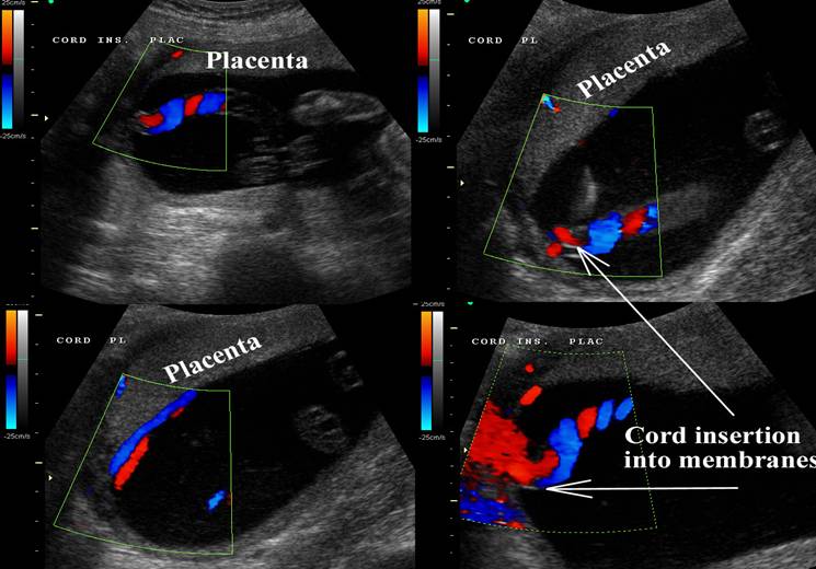 Velamentous Cord Insertion Ultrasound Velamentous Cord Insertion Ultrasound