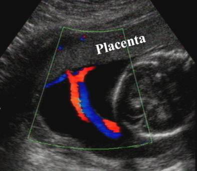 Battledore Placenta