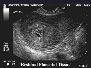 retained placental fragments retained placental fragments