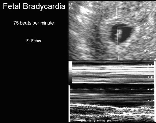 low-fetal-heart-rate-success-stories