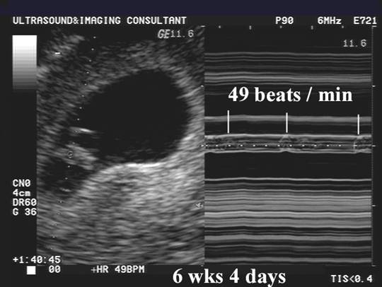 normal heartbeat for 10 week fetus