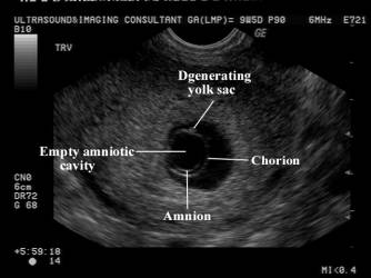 Gestational Sac in Pregnancy and Meaning If Empty