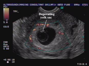 Gestational Sac in Pregnancy and Meaning If Empty