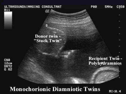 Twin-Twin Transfusion Syndrome (TTS)