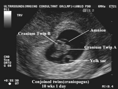 Ultrasound of Conjoined Twins