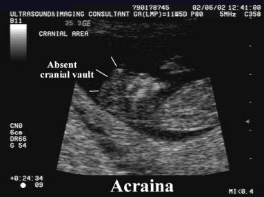 Image result for cranial irregularities during first trimester ultrasound"