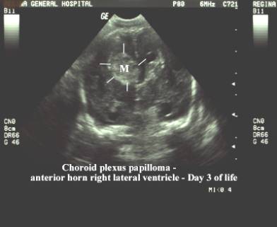 choroid plexus papilloma usg szemölcsök immunmodulátorai