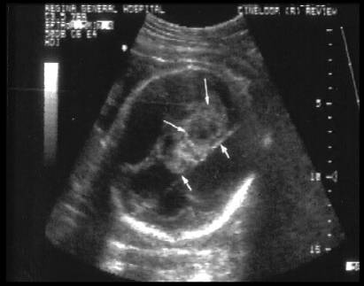 choroid plexus papilloma usg)