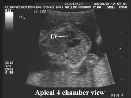 ECHO picture with hyperechoic moderator band in the right ventricle