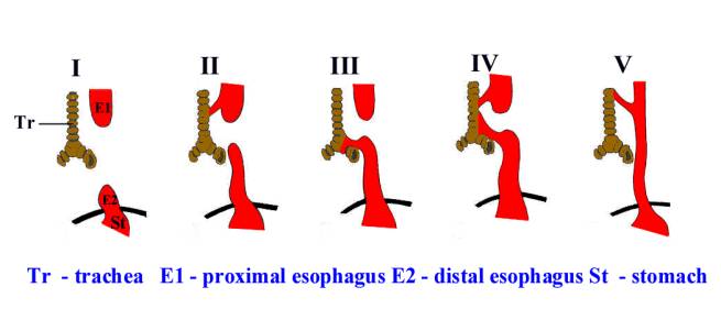 Esophageal atresia