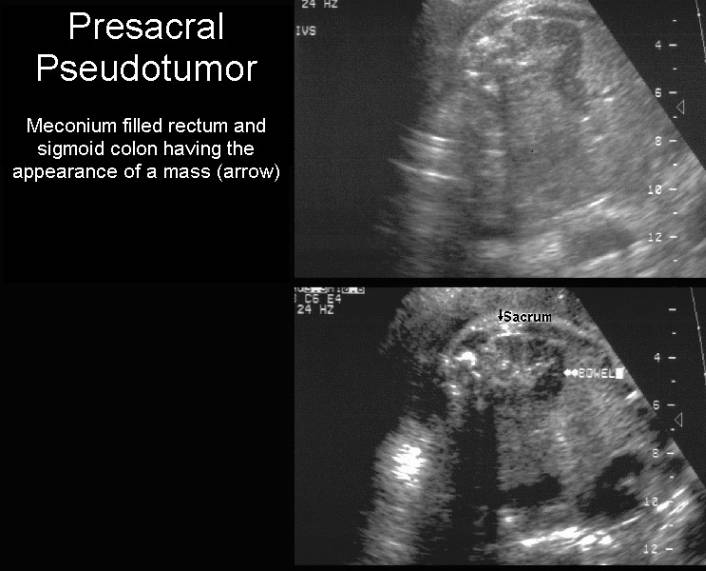 Newborn assessment imperforate anus - Porn galleries assessment anus Newborn imperforate