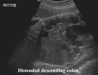 Anorectal Atresia Imperforate Anus