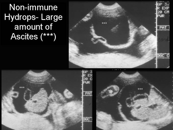 Ultrasound Of Fetal Ascites