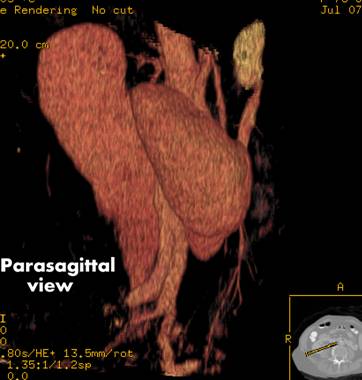 Horseshoe Kidney Complications. Horseshoe Kidney