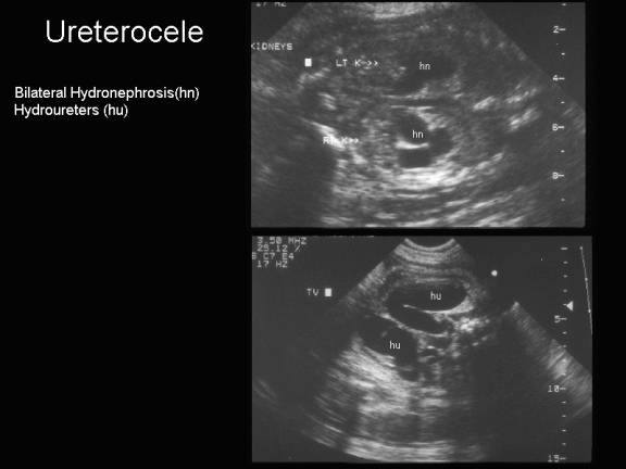 Ureterocele