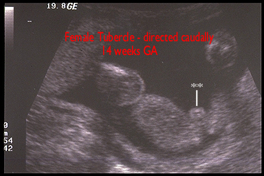 Fetal Sex Ultrasound 34