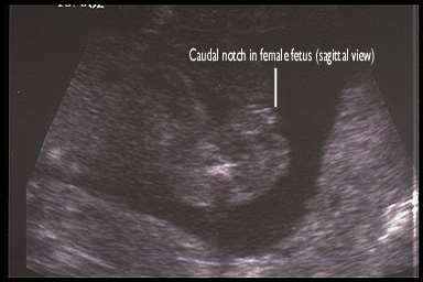 Ultrasound Of Anal Sex - Ultrasound Fetus Sex - Adult videos