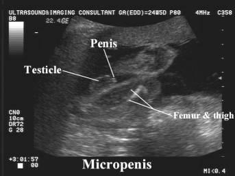 Micro penis causes What Is
