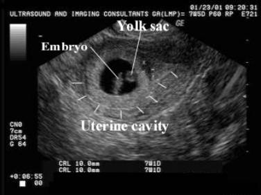 Fetal Anomalies Associated With Breech Presentation