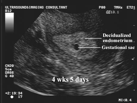 What Is A Gestational Sac The Gestational Sac In Pregnancy TVHG