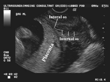 Transvaginal Ultrasound In Placenta Previa