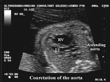 Coarctation of the Aorta