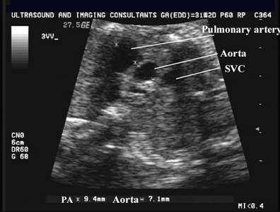 Coarctation of the Aorta