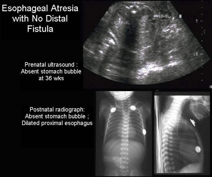 Tracheoesophageal Fistula Ultrasound