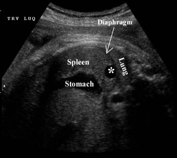 Fetal Splenic Cysts