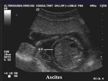 Ultrasound Of Fetal Ascites